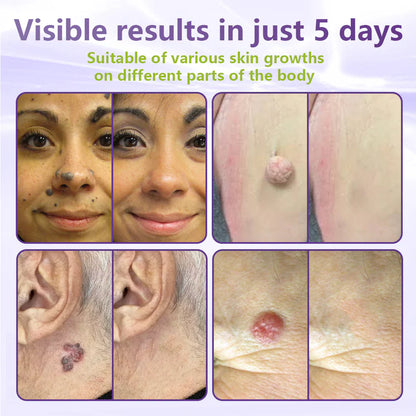 MicroNeedle Botanic Skin Tag Removal Patch