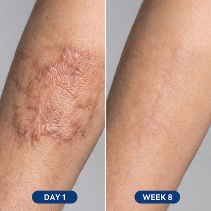 Flatter, Smoother, Calmer Scars in as Little as 3 Days